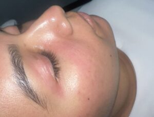 Hydrafacial Después 1