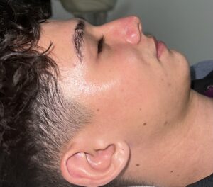Hydrafacial Randall después 4
