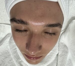 Hydrafacial antes