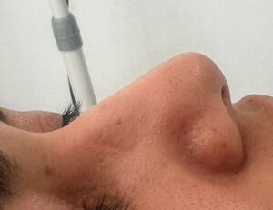 Hydrafacial antes 1