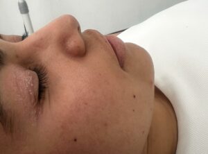 Hydrafacial antes 2