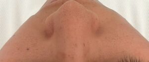 Hydrafacial antes 3