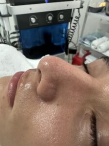 Hydrafacial antes Randall