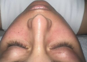 Hydrafacial después 2
