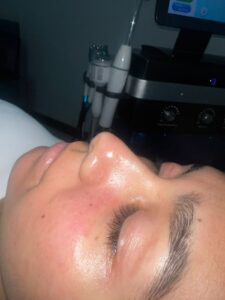 Hydrafacial después 3