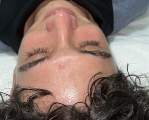 Hydrafacial después Randall 1