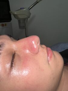 Hydrafacial después Randall 2