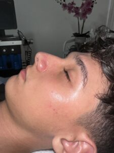 Hydrafacial después Randall 3